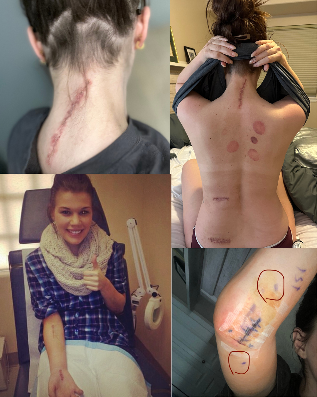 My CRPS Journey Part 5 (and final)