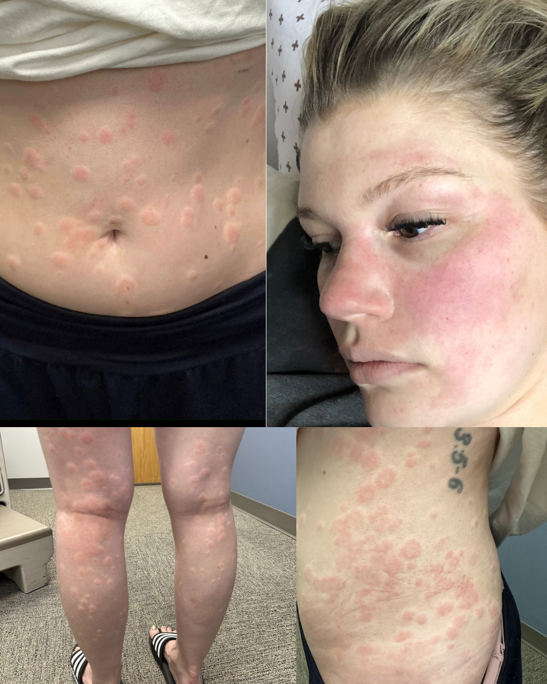 Mast Cell Activation Syndrome: An Unpredictable Storm